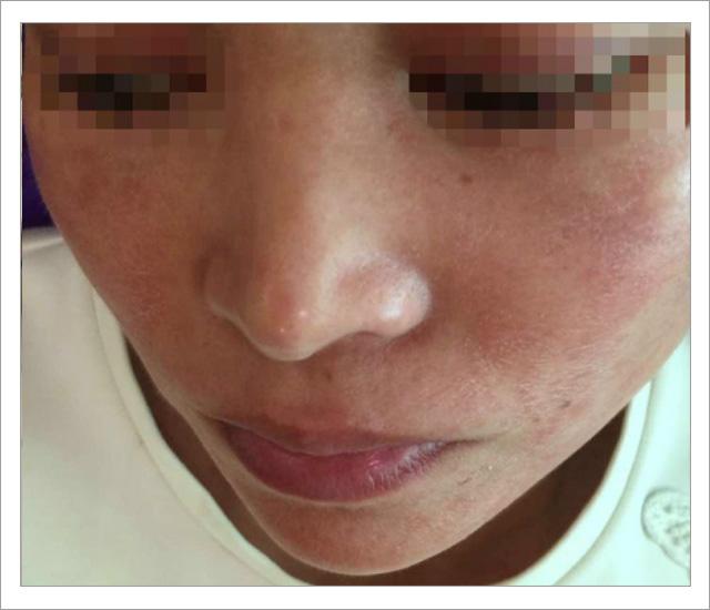 脸上螨虫的正确消灭方法,脸上的螨虫能不能彻底消灭