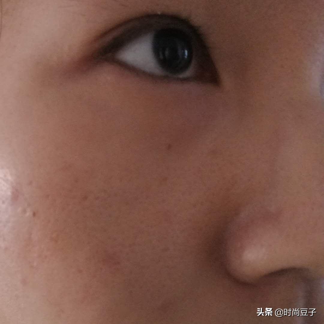 痘肌混油皮适合的补水喷雾,适合油痘肌的四大神水