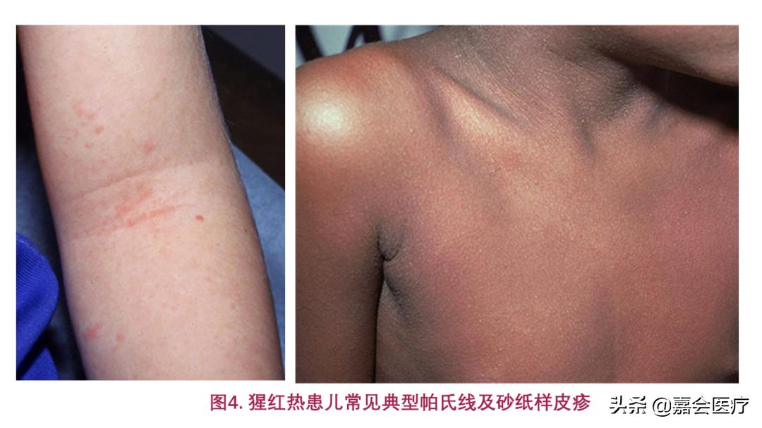 孩子只有草莓舌和发热是川崎病吗,川崎病草莓舌的症状