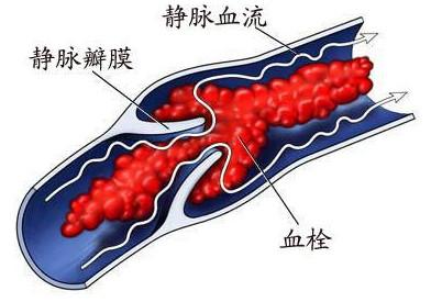 关节置换术后伤口肿胀原因,全髋关节置换五个月了怎么刀口痛