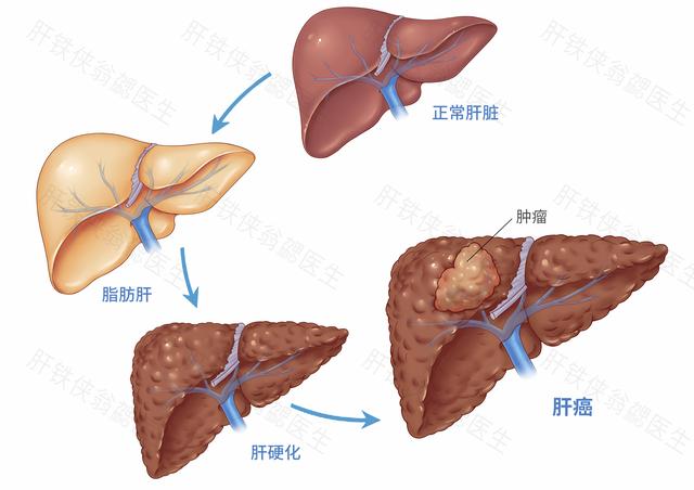 为什么胖子容易得脂肪肝,为什么有些胖子没有脂肪肝