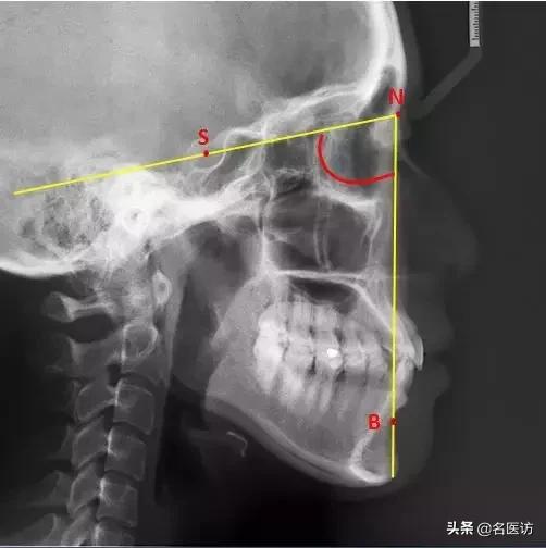 矫正科普|美人在骨不在皮，从神秘的牙片看牙齿和侧貌颜值