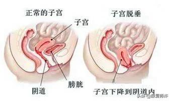 产后腹直肌分离恢复瘦肚子训练,产后腹直肌分离恢复的最佳方法