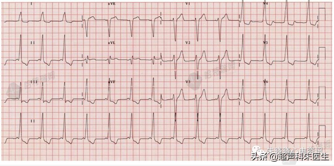 t波倒置9个真相图解,t波倒置判断口诀