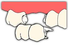 上门牙缺失3颗做牙桥修复方案,缺牙缝隙大能做固定桥修复吗