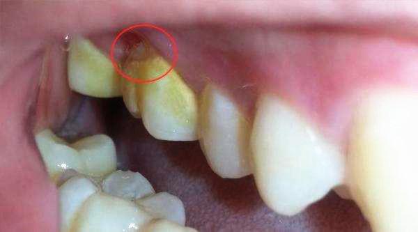 牙缝里黄黄的很硬,牙缝里黄黄臭臭的东西是什么