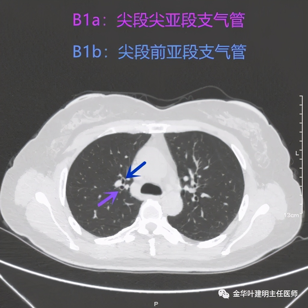 左肺上叶在ct影像上怎么看,平扫ct可以看出肺肿瘤的变化吗
