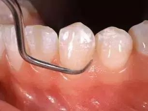 为什么有些洗牙很便宜,为什么洗牙价格差别那么大