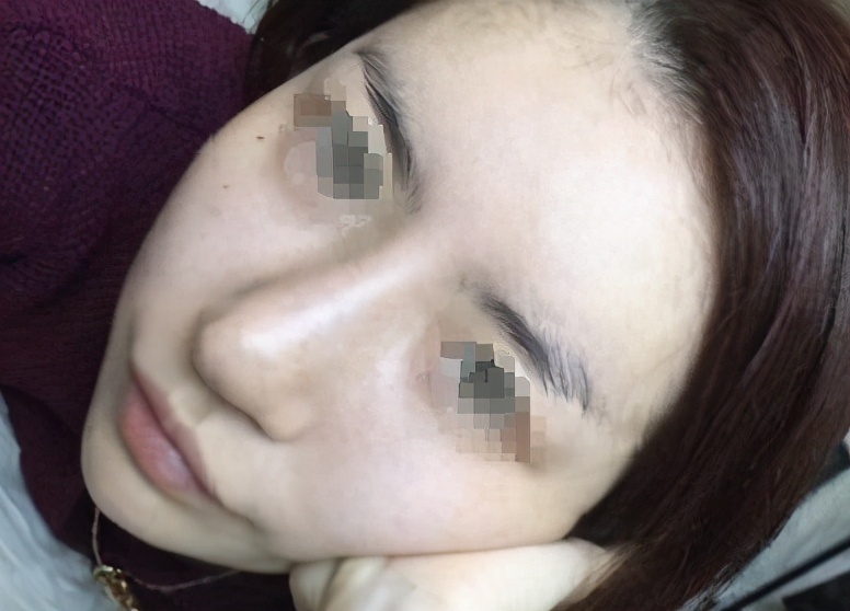 成功的鼻子以后要修复吗,隆鼻修复四次成畸形鼻