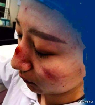 用消毒液过敏吃什么药,戴口罩皮肤过敏擦什么药膏