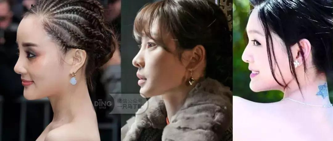 凹面型侧脸怎么改善,凹面型侧脸是怎么造成的