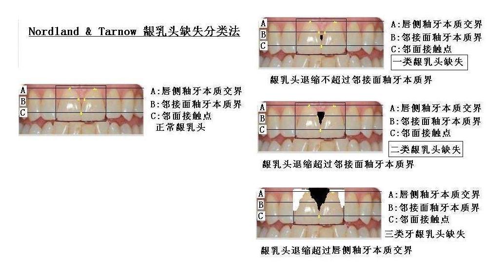 牙齿严重黑三角怎么补救,牙齿出现黑三角能矫正吗