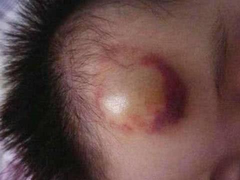 半岁婴儿从床上掉下昏迷至今，宝宝坠床，这种处理方法能避免悲剧