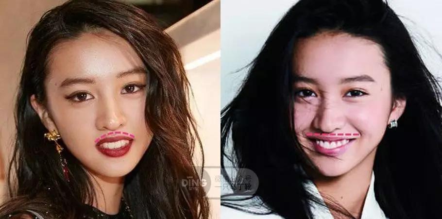 戴牙套凸嘴怎么化妆,凸嘴整牙削骨吗