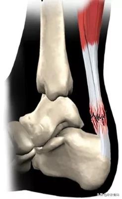 跟腱断裂的确诊方法,超详细跟腱断裂的诊断与治疗