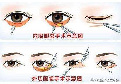 用什么样的眼霜可以缓解泪沟眼袋,眼袋和泪沟用眼霜效果好吗