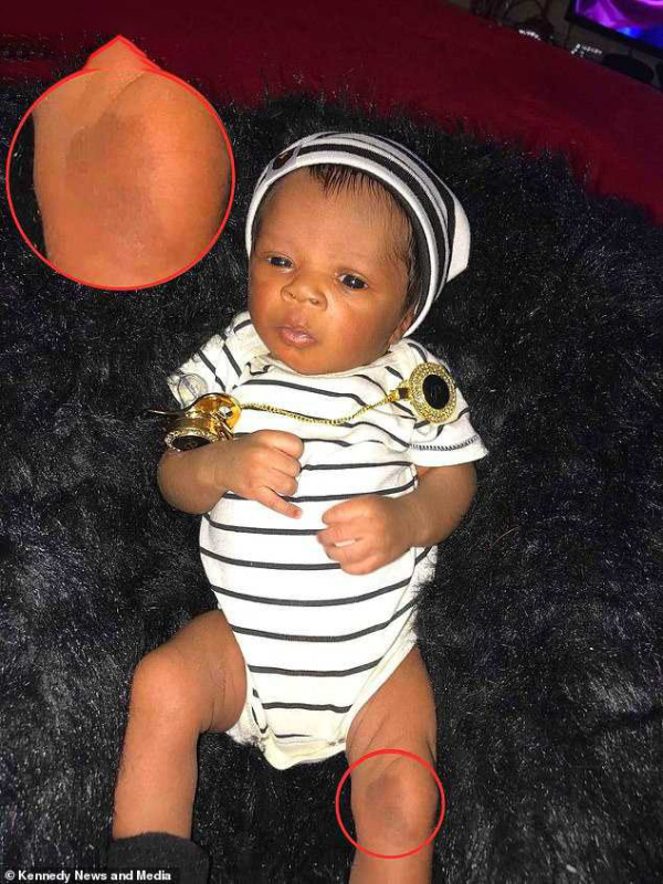 最美胎记，姐姐在胎中被弟弟“吸收”，将B超影像留在了弟弟腿上