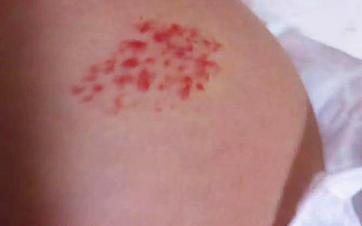 百天宝宝患有血管瘤,激光、敷药该如何抉择?愁坏妈妈