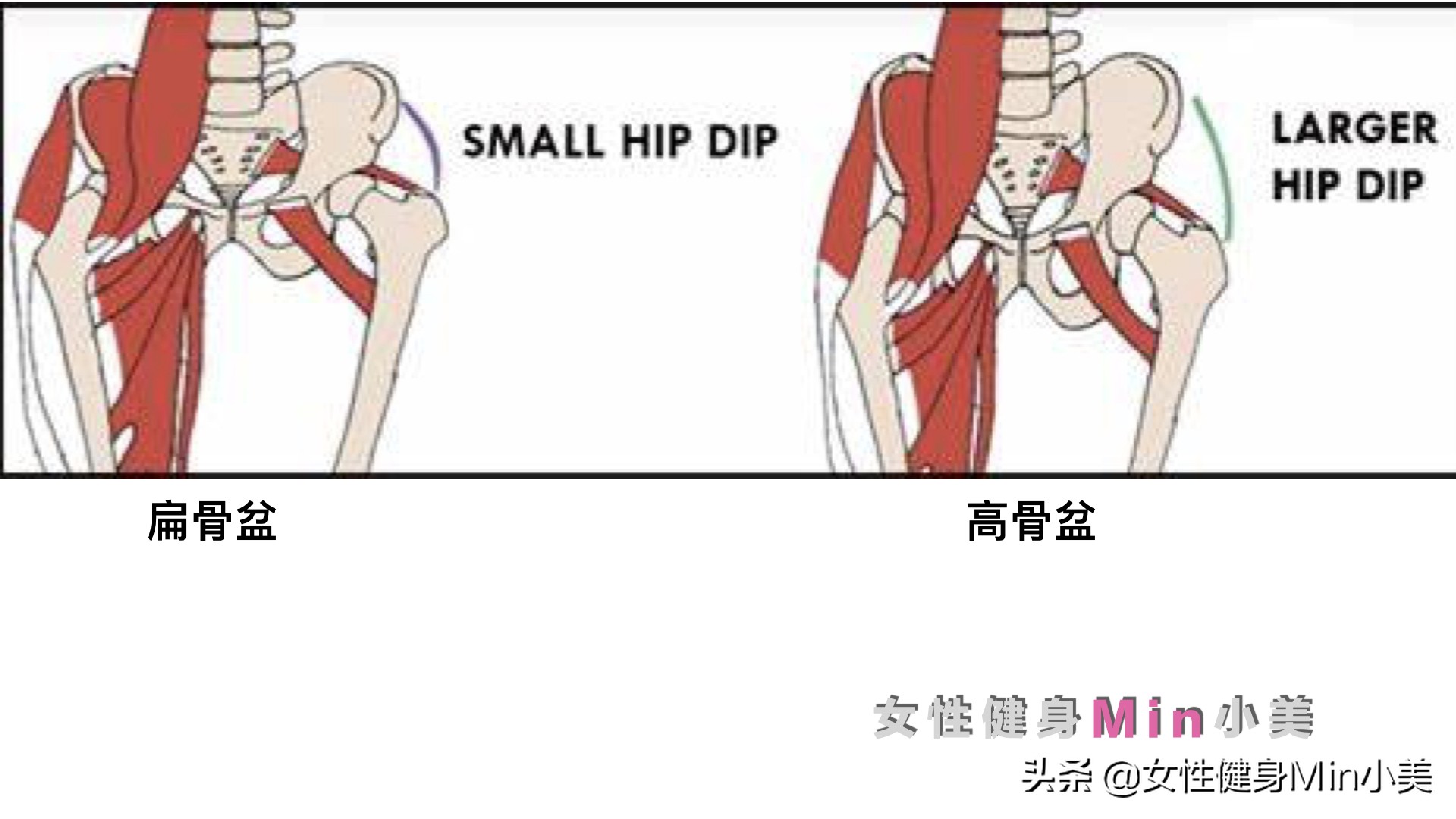 臀中肌变大是怎么回事,臀凹陷不能全是练臀中肌解决