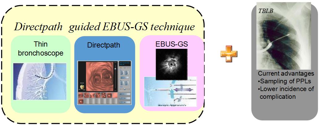 小细胞肺癌的气管镜介入治疗,导航支气管镜在肺癌诊断中的应用