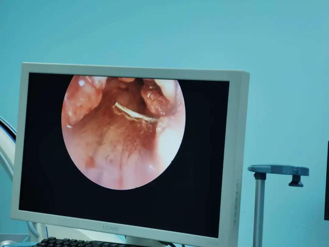 女子手指发麻是怎么回事,女子手麻是什么原因