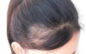 米诺地尔治疗脱发成功案例 (米诺地尔治疗脱发的正确使用方法)