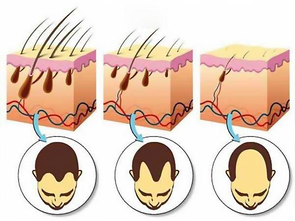 别为了硬凹发型，低估了劣质啫喱水的*伤杀**力