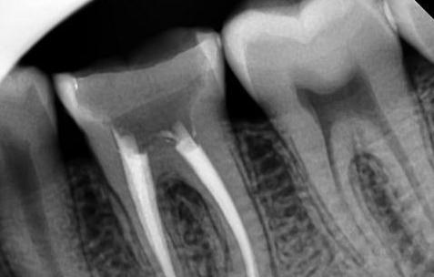 没有牙髓用根管治疗吗,牙体牙髓治疗与根管治疗的区别