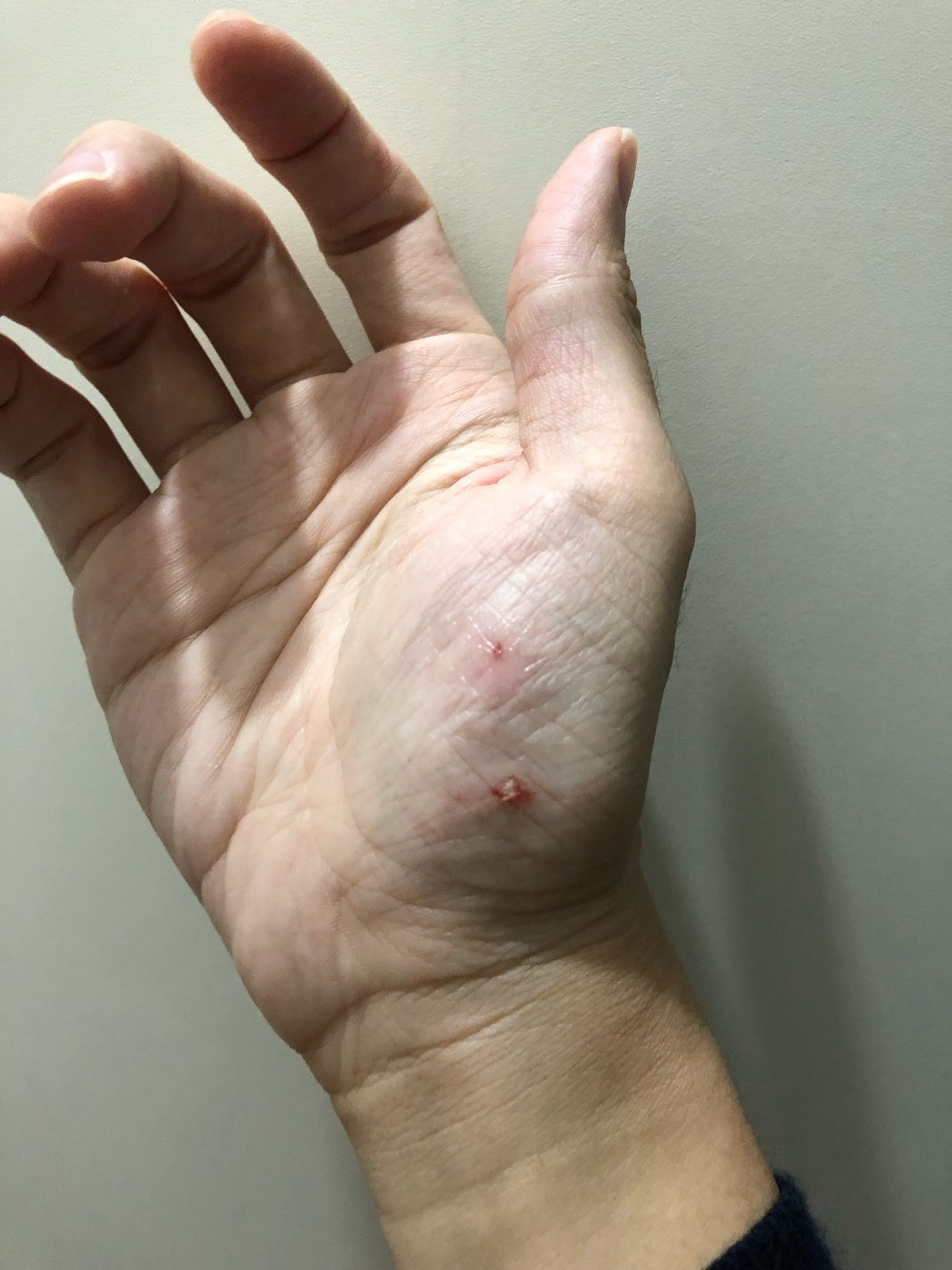 被自家狗狗伤需要打疫苗吗,被狗狗咬伤的位置红肿痛正常吗