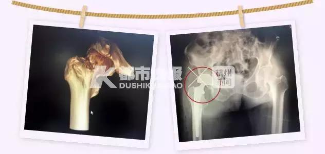 90岁老人摔倒骨折要不要手术,90岁老人得重病是治疗还是放弃