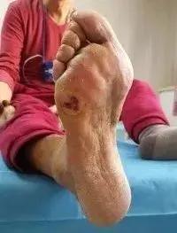 糖尿病脚底疼是不是并发症,糖尿病并发症脚底脱皮严重