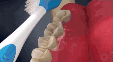 牙齿矫正好以后又长智齿,儿童牙齿矫正佩戴钢丝会更蛀牙吗