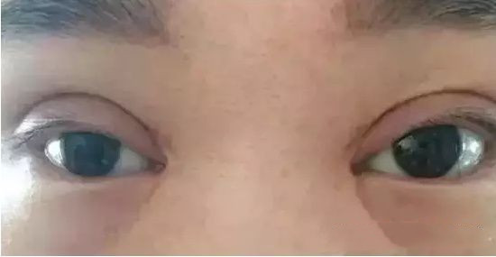 怎样修复双眼皮线条,上海修复肉条双眼皮哪里做的好