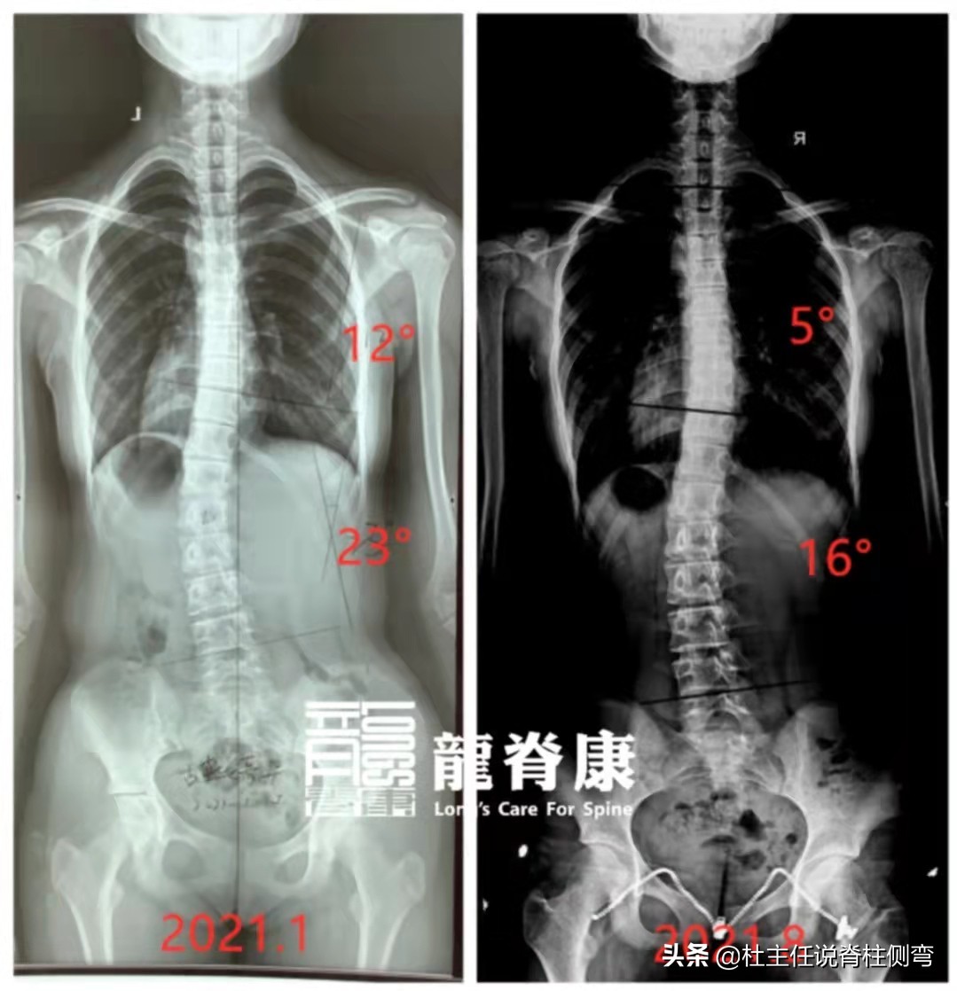 14岁女孩侧弯治疗一年后,12岁女孩脊柱s型侧弯17度怎么治