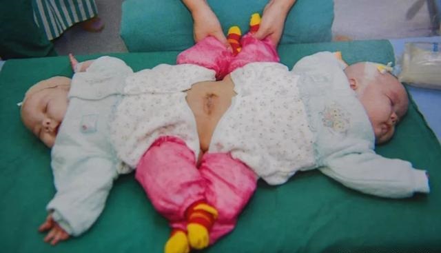 中国首例坐骨连体双胞胎现状,坐骨连体双胞胎多大分离