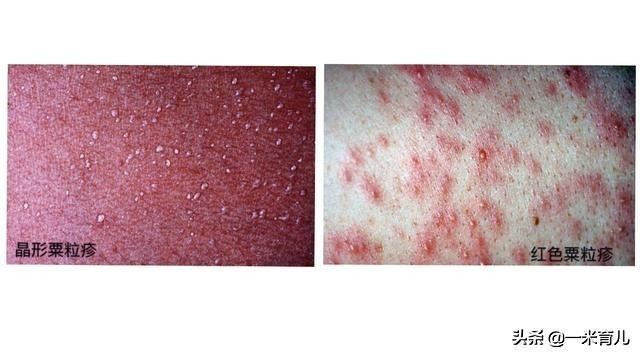 婴幼儿中暑应该如何处理如何预防,儿童预防中暑的健康小知识