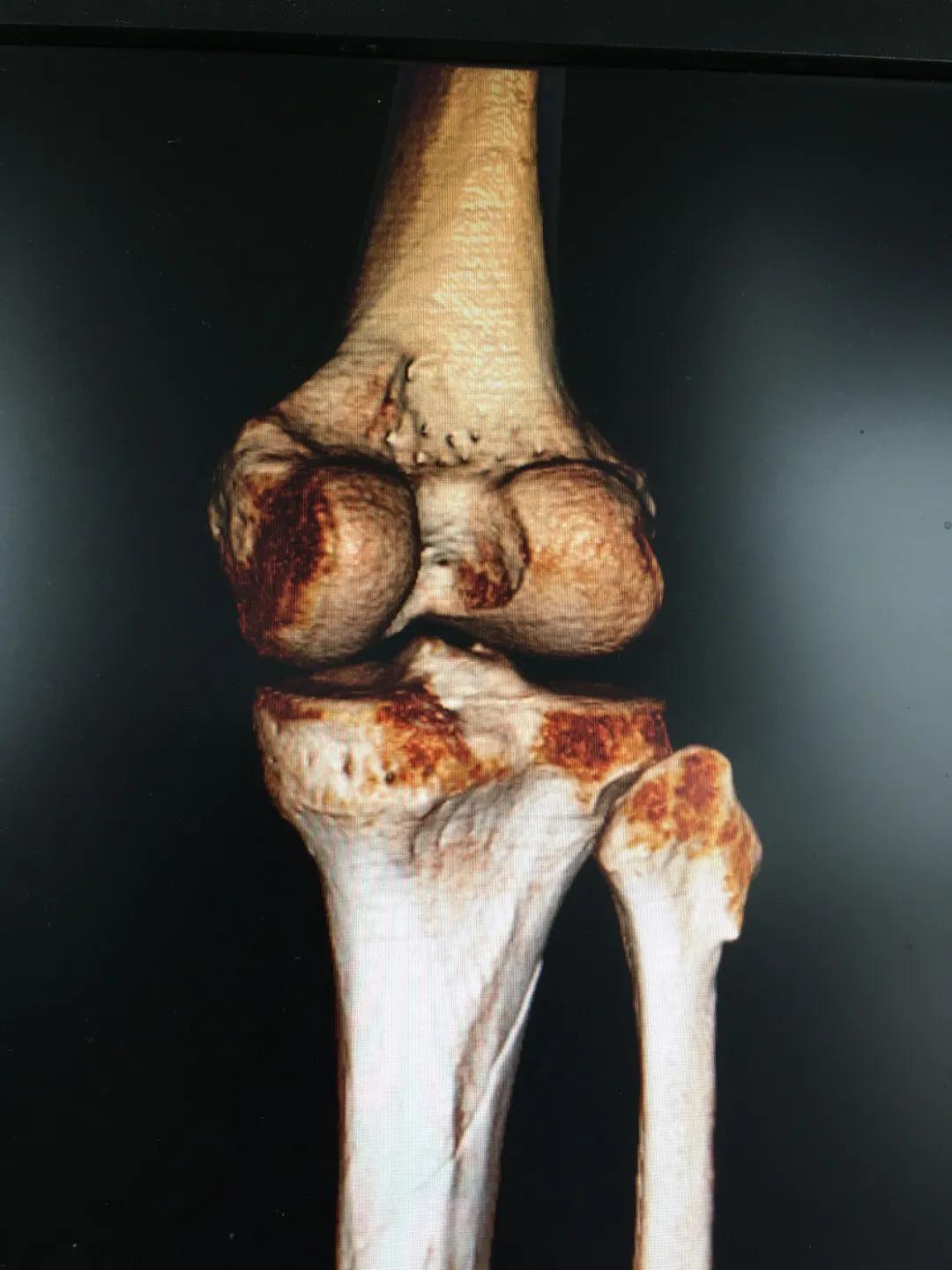 小腿骨断成三截了还能恢复吗,小腿断了三截能好彻底吗