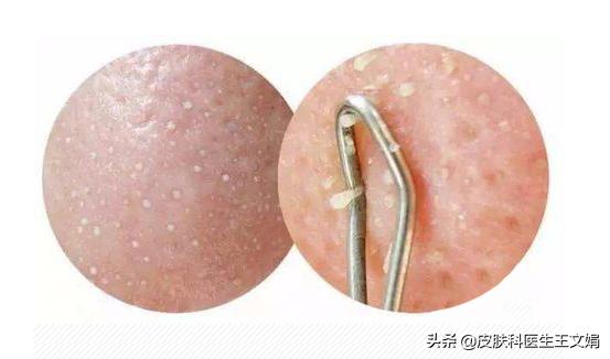 伴随一生的皮肤病,伴随一身的皮肤病有哪些