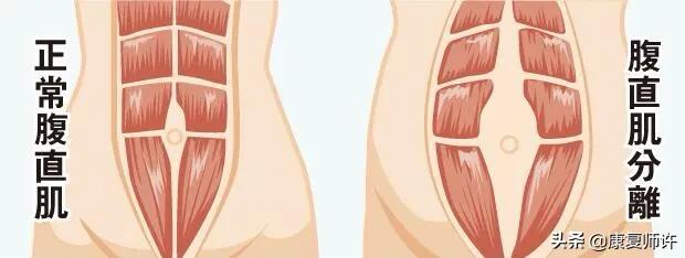 产后腹直肌分离恢复瘦肚子训练,产后腹直肌分离恢复的最佳方法