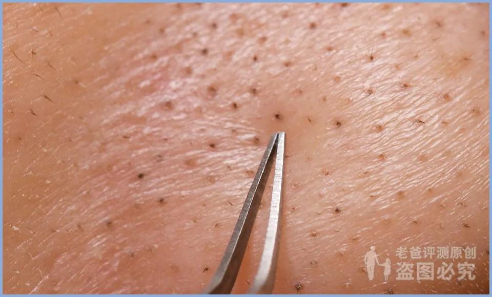 正确科学的去黑头方法一次说清楚,正确的去黑头的方法在这里