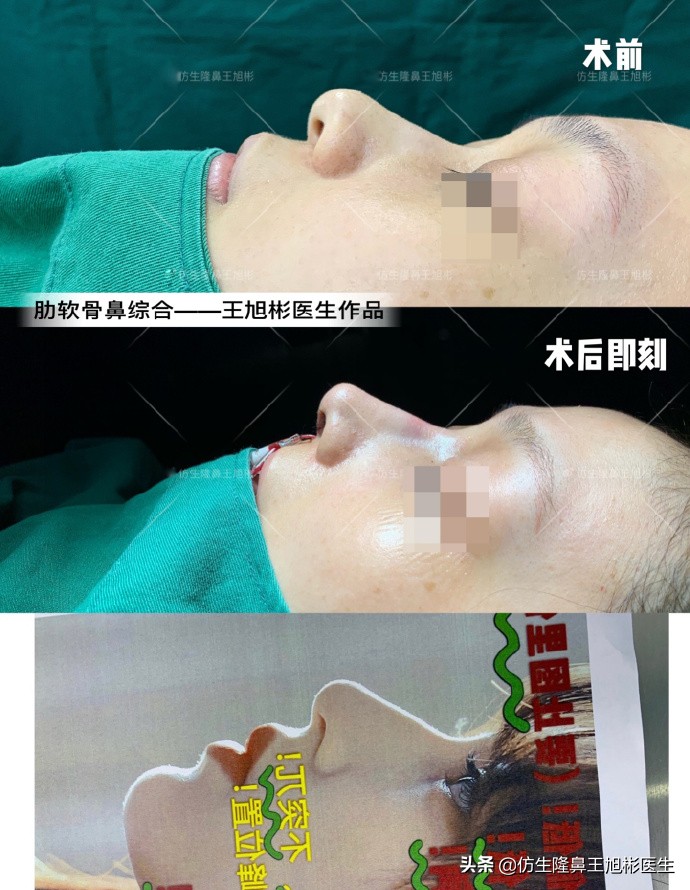 大鼻头能做直鼻微翘吗,可以只做鼻头缩小术吗