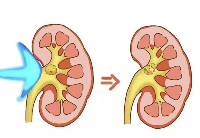 导致腰痛的肾结石严重吗,腰酸背痛是肾结石吗