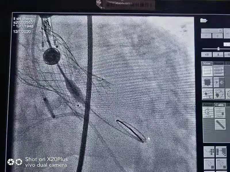 南宁股骨头置换,南宁股骨头置换在哪个医院比较好