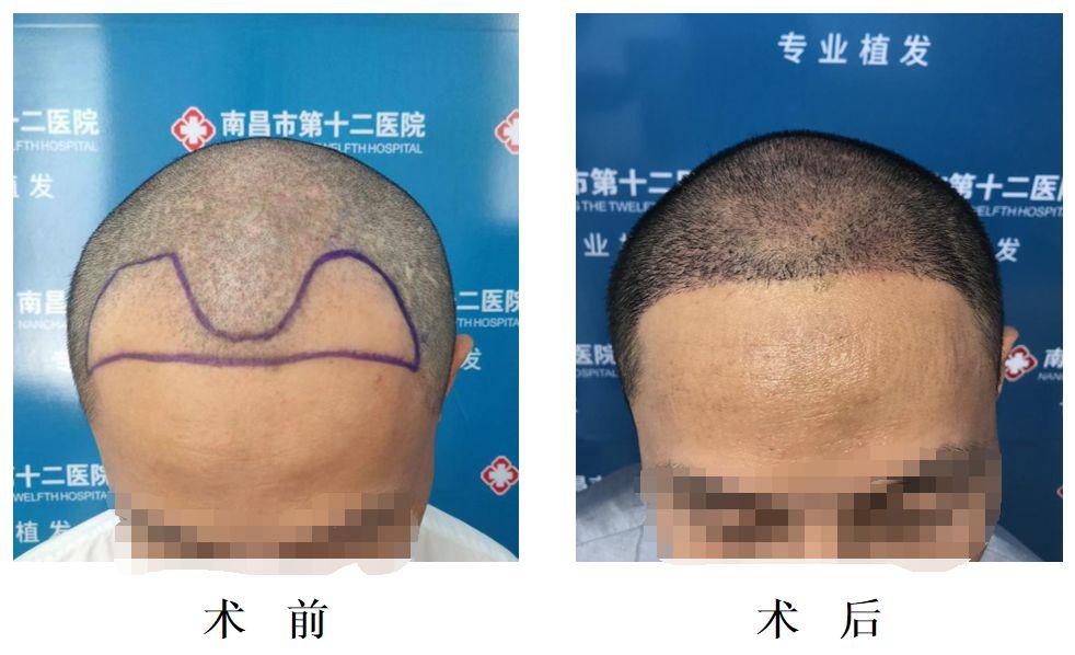 头发种植是怎么操作的,头发种植利弊有哪些呢