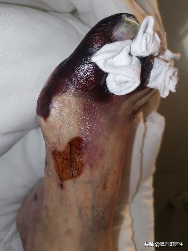 脚趾是平的是糖尿病足么,糖尿病足脚趾甲会什么样