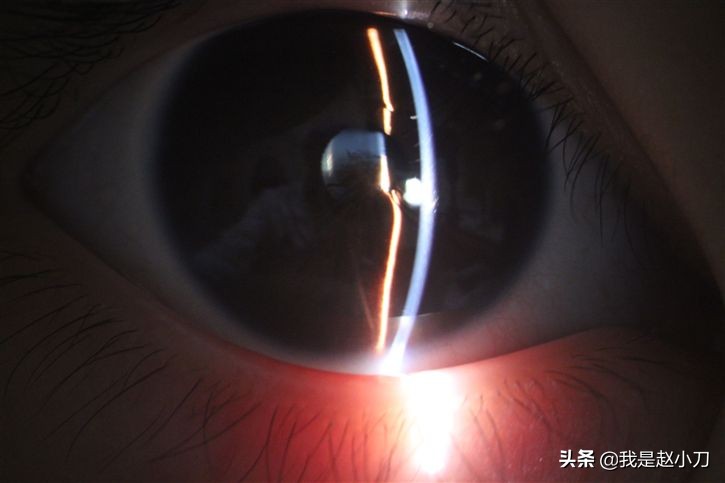 赵小刀白内障手术,先天性瞳孔残膜手术需要多少钱