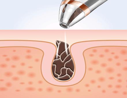 长期使用美容仪斑会淡吗,长期使用美容仪皮肤会提亮吗