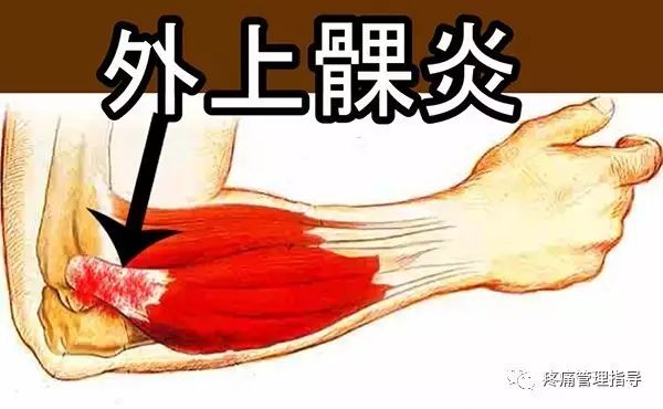 网球肘能自我恢复吗,网球肘病因的解剖学研究