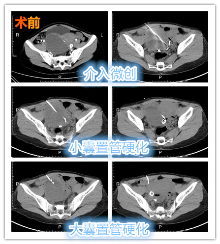 卵巢巧克力囊肿可以自然怀孕吗,卵巢有巧克力囊肿怎么治