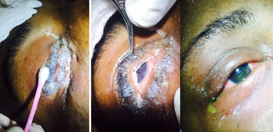 502误当眼药水,宝宝误把502胶水当成眼药水